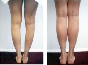calf-implants1