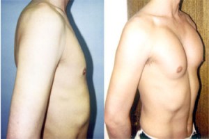 pec-implants1