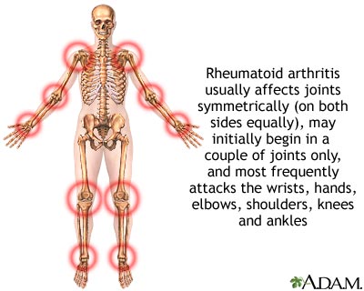 arthritis arthritis