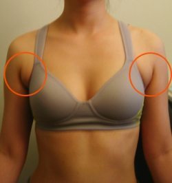 I feel really embarassed about my armpit fat. I am skinny and tall and it  is the only area where I have this fat (Photo)