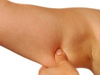flabby arms